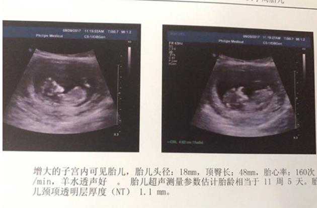武汉寻找代生妈妈 武汉协和医院供精姐妹经历 ‘孕囊与nt值看男女’
